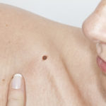 Men & Women have both benefited from having their unwanted moles removed at our clinic here in London 