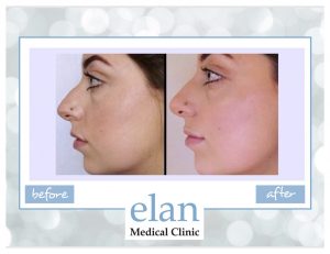 Rhinoplasty in Essex