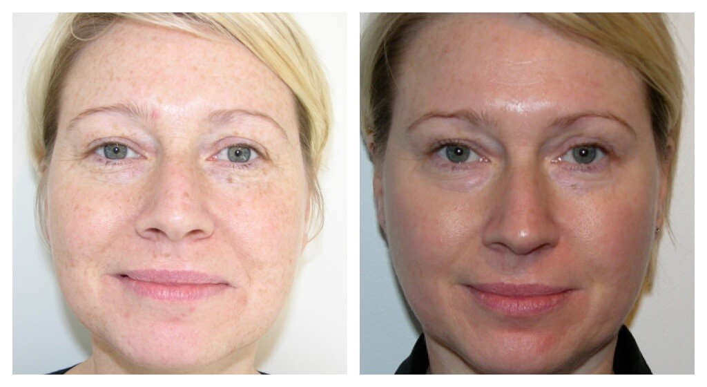 Fractional skin resurfacing essex Fractional Skin Resurfacing Essex | Elan Medical Skin Clinic in Essex