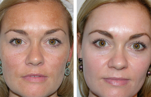 Skin discoloration Essex & London | Skin pigmentation Essex