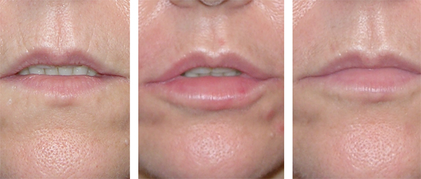 Natural looking lips with our dermal filler injections - Lip injections London