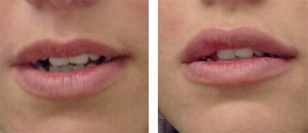 Natural lip enhancement by Sue Ibrahim